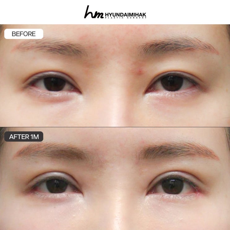 Choosing the right eye revision surgery clinic makes all the difference in your results