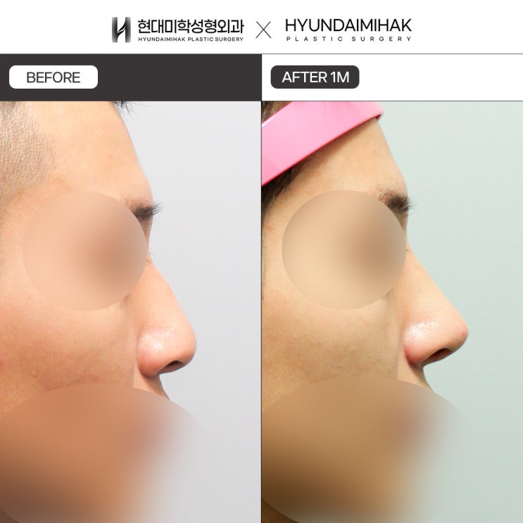 Male Rhinoplasty Before and After: For a Natural Yet Strong Impression