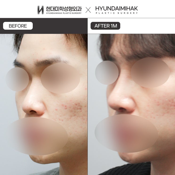 How to Achieve a Natural-Looking Male Rhinoplasty