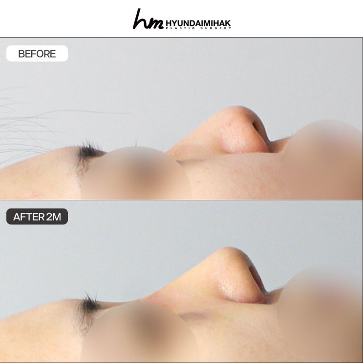 Reduce the burden of bulbous nose surgery costs and change your overall impression