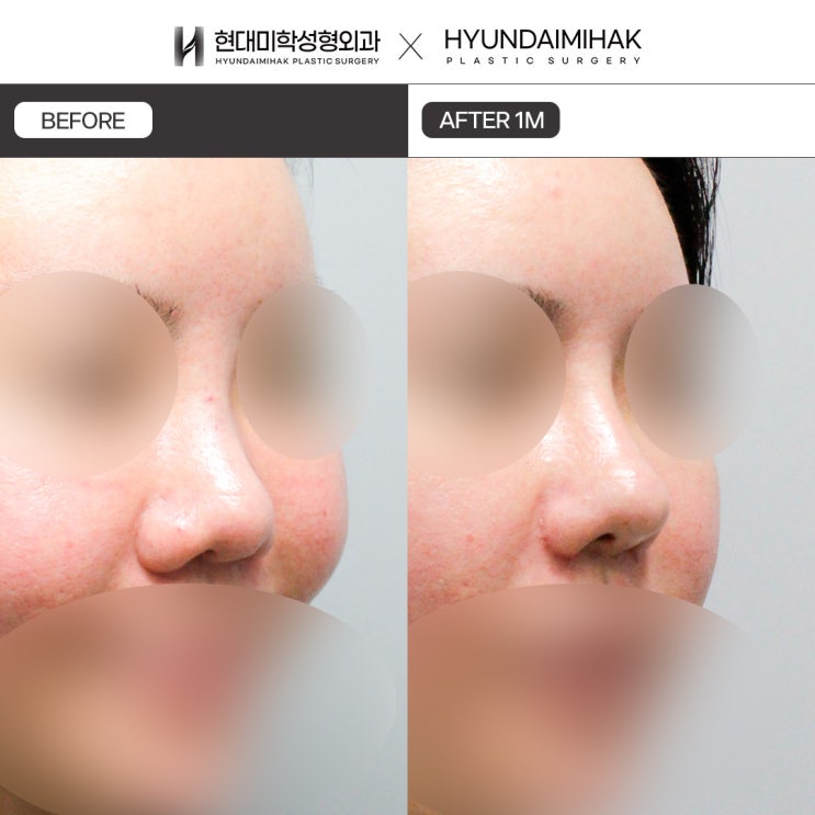 Bulbous Nose Surgery Before and After: How to Achieve a Refined, Smooth Nasal Tip