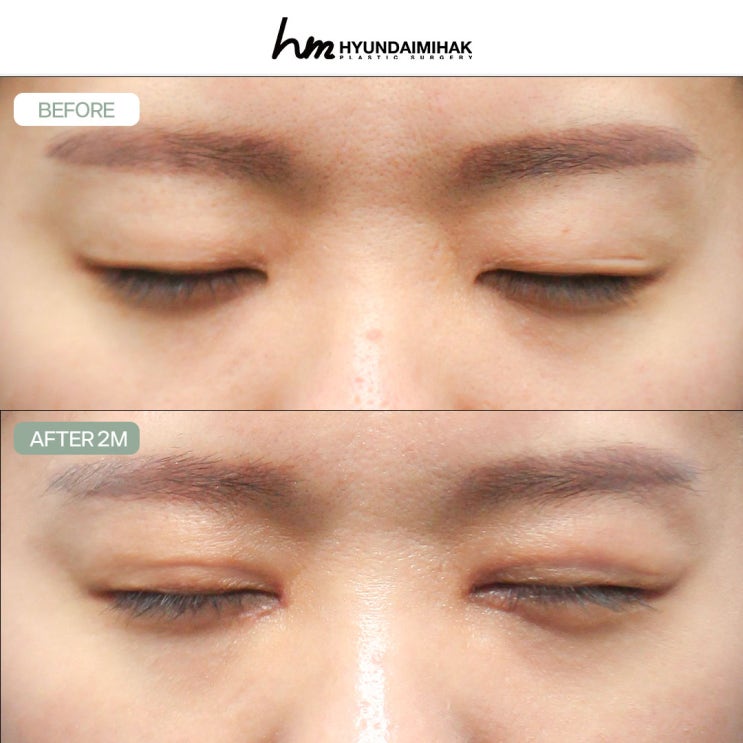 Correction of Drooping Eyes｜A delicate procedure that makes the eyes clearer and changes the overall impression