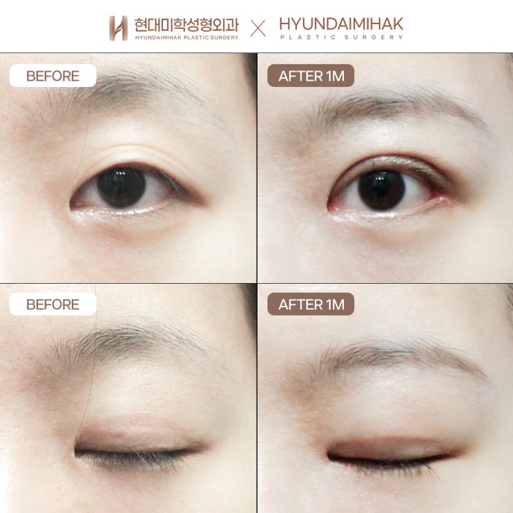 What to Check When Looking for a Clinic Skilled in Revision Eyelid Surgery