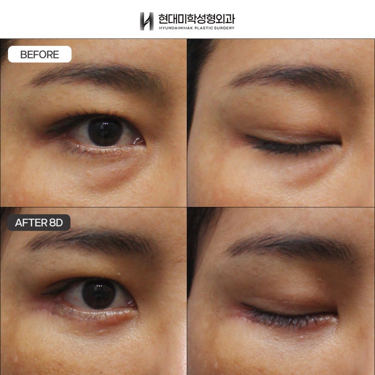 Under-eye fat repositioning clinic for youthful, lively-looking eyes