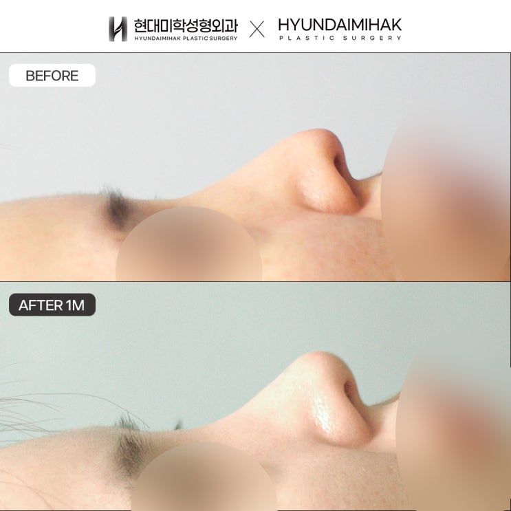 Reasons for tip revision surgery can vary, including changes in shape