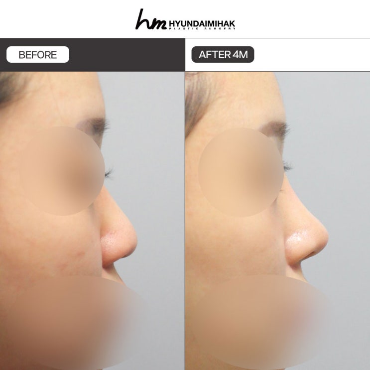 How to Choose Rhinoplasty Materials: Hyundai Aesthetic Surgery Explains