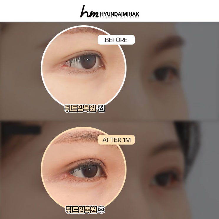 Restoring Lateral Canthoplasty for a Natural Eye Shape