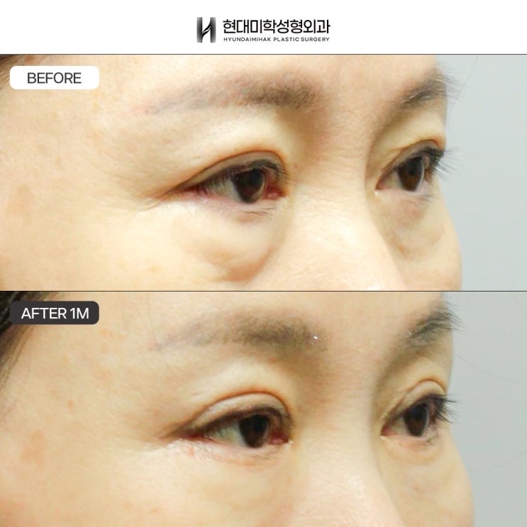 Lower Blepharoplasty for Middle Age: Bulging Under-Eye Fat
