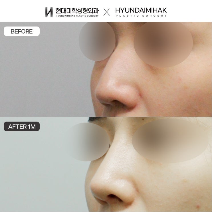 Carefully choose a clinic experienced in nasal osteotomy