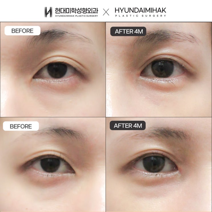 Medial Epicanthoplasty Revision: How to Recover from a Failed Medial Epicanthoplasty