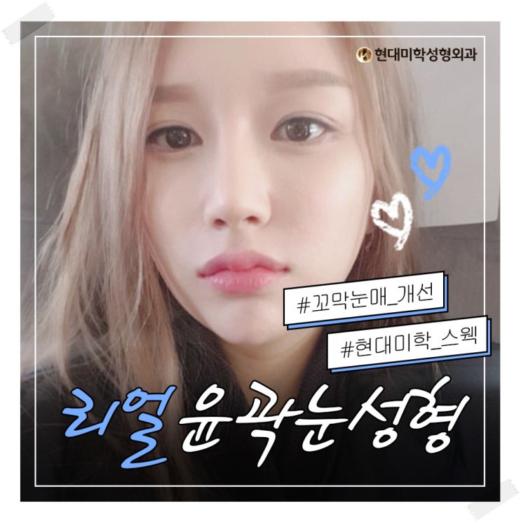 Real Double Eyelid Surgery Reviews: Find Out for Yourself