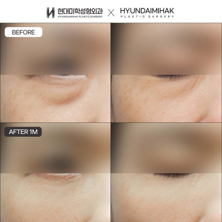 Changes in the eye shape caused by aging of the upper and lower eyelids