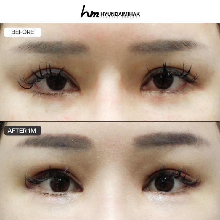Ptosis Correction Review: Quickly Moving Beyond a Sleepy-Looking Impression