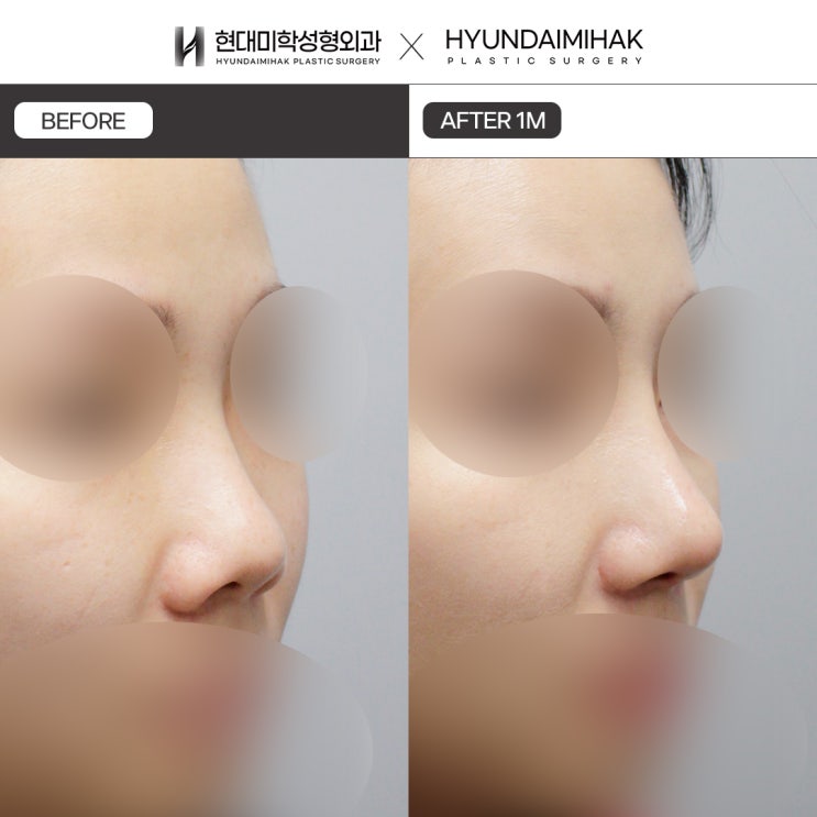 Upturned Nose Surgery Cost: The Side Profile Should Be Improved Too