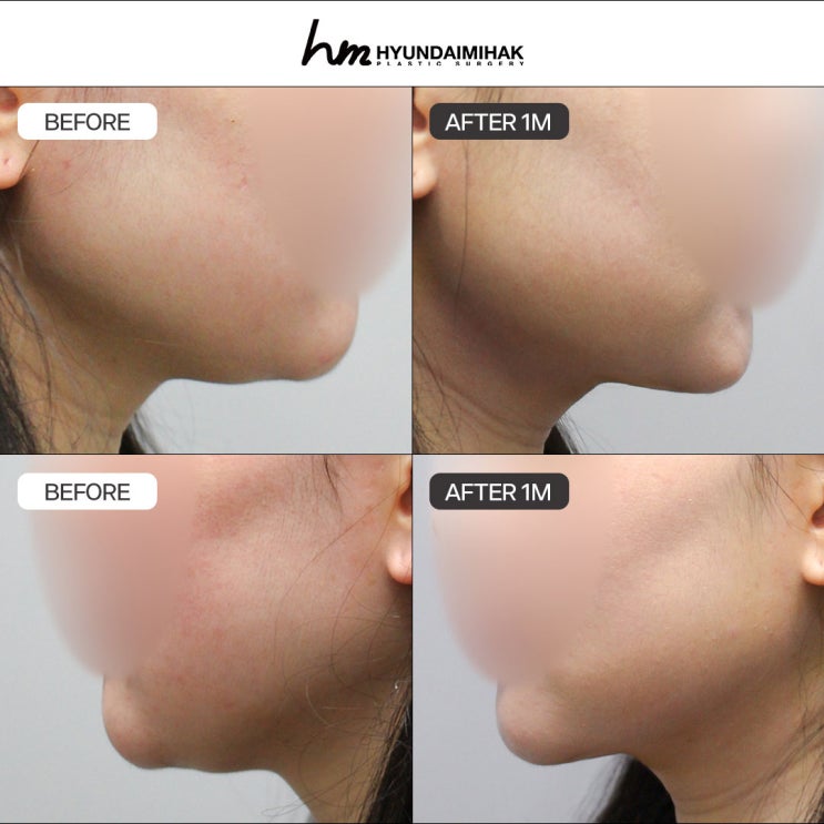 Double Chin Liposuction: Don’t Put Off Looking Your Best