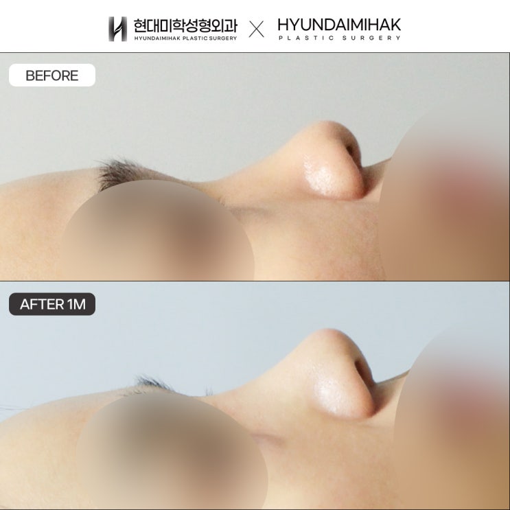 Understanding the Straight-Slightly Curved Line and Various Nose Line Types