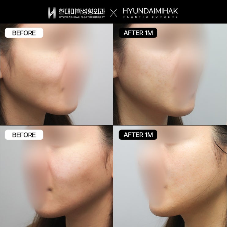 How to Create a Natural and Safe V-Line Without Cheekbone Reduction Surgery