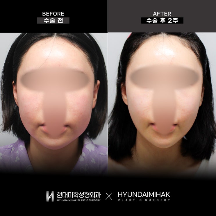 Before and After Facelift: This Is How the Lifting Effect Appears