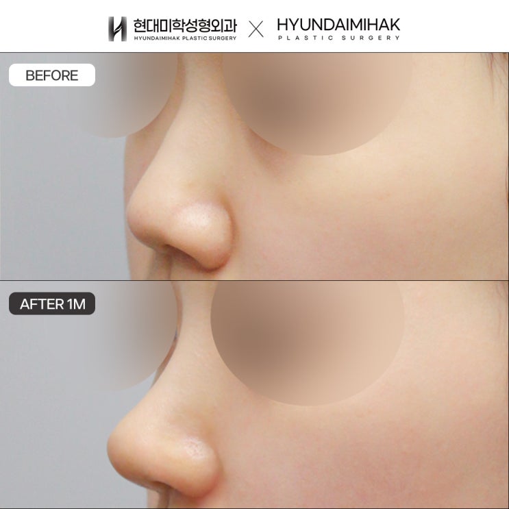 A clinic skilled in bulbous nose correction for a naturally slim, refined nose
