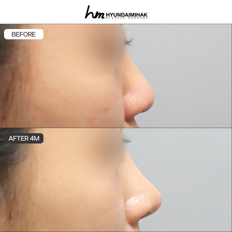 Essential Information to Check Before Choosing a Nose Line Type