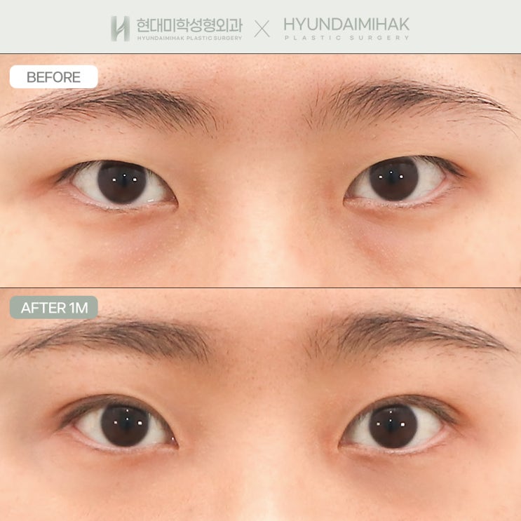 Natural adhesion double eyelid surgery for a natural and attractive change