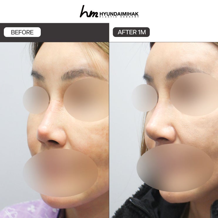 Why the Cost of Crooked Nose Surgery Varies So Much from Person to Person
