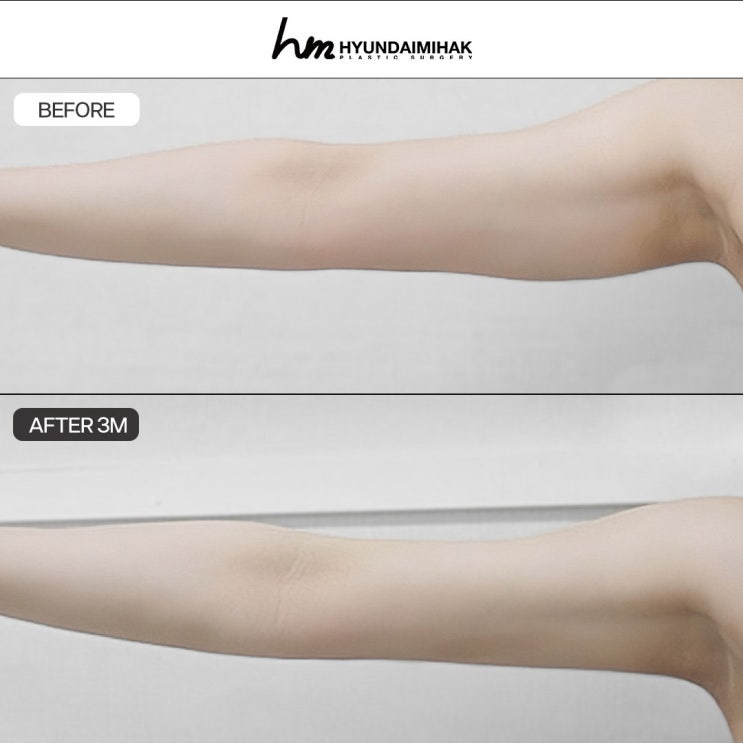 Liposuction Before and After: Changes by Area and Realistic Reviews｜How Much Can It Really Change?