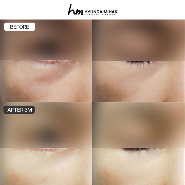 Lower blepharoplasty cost: criteria for choosing an experienced clinic