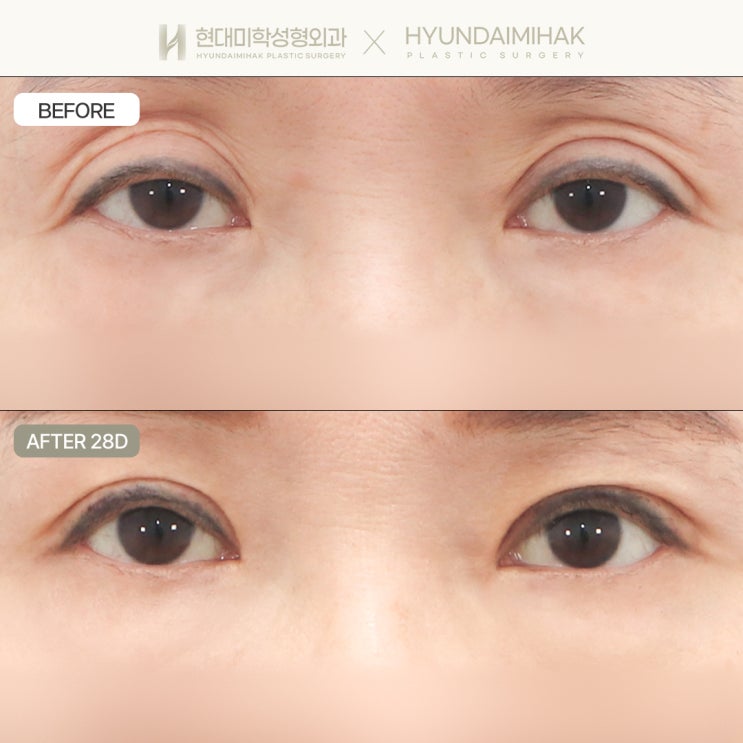 Before and after lowering the crease line: resolving excessive crease thickness