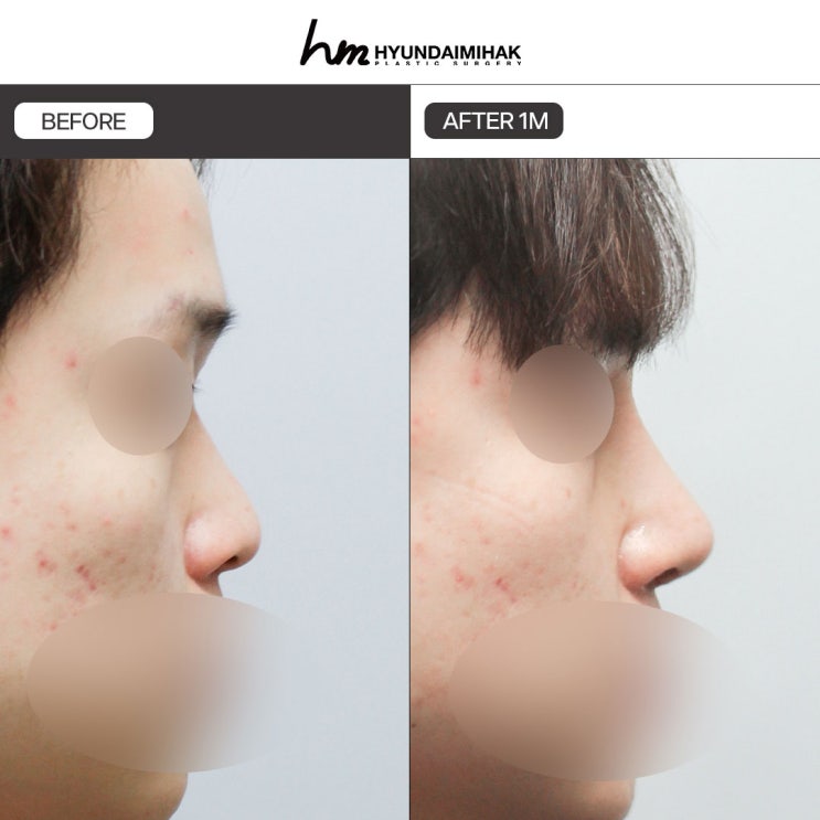 How is male rhinoplasty different, and how should you choose?