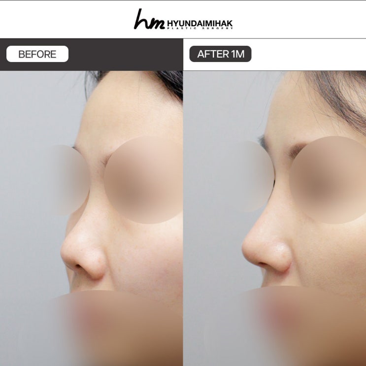 Upturned Nose Correction: How to Create a Refined, Three-Dimensional Impression