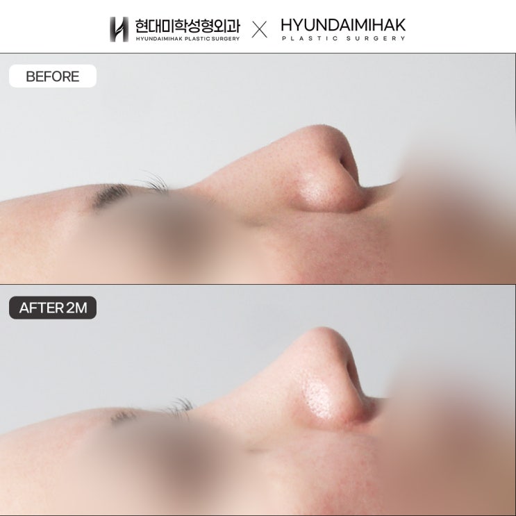 If You Want Natural Results with Implant-Free Nasal Tip Surgery