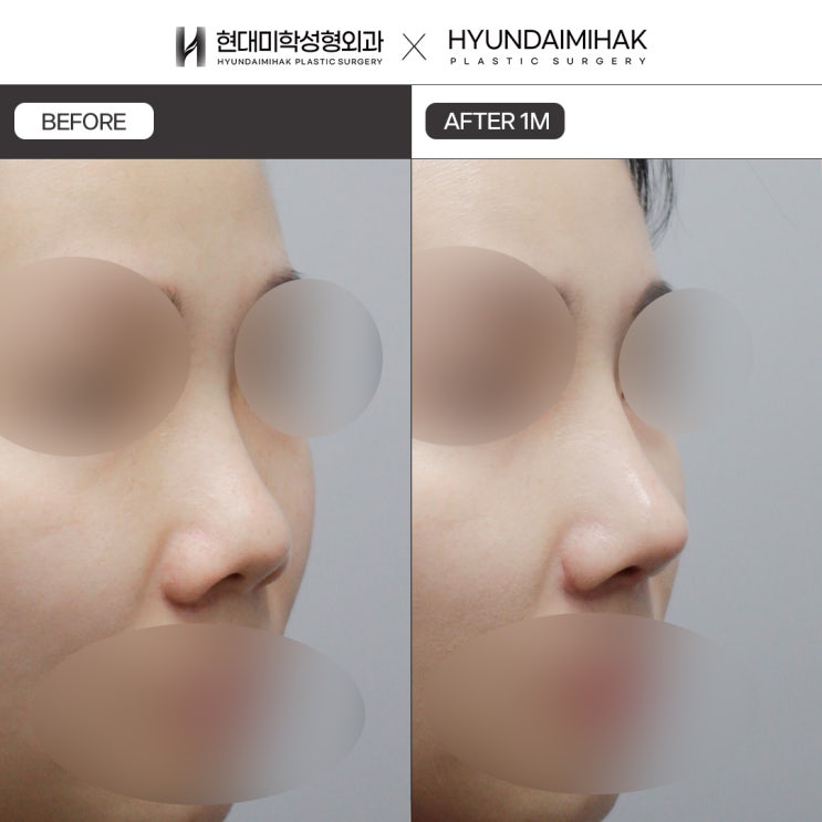 Upturned Nose Surgery: A Solution to Regain Your Confidence