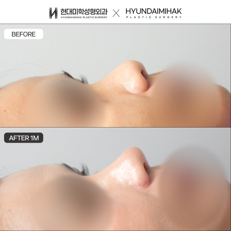 What factors determine the cost of bulbous nose surgery?
