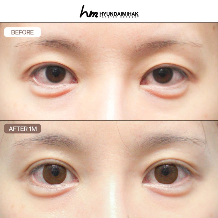 Technical expertise to correct failed revision eye surgery