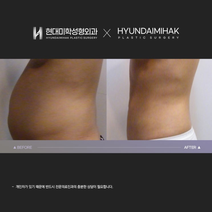 Wegovy prescriptions are available at Hyundai Aesthetic Surgery