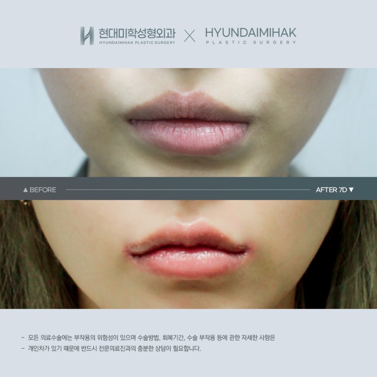 Creating Defined, Voluminous Lips with Cupid’s Bow Line Surgery