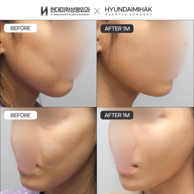 Gangnam Thread Lifting Clinic: The Beginning of Natural Lifting