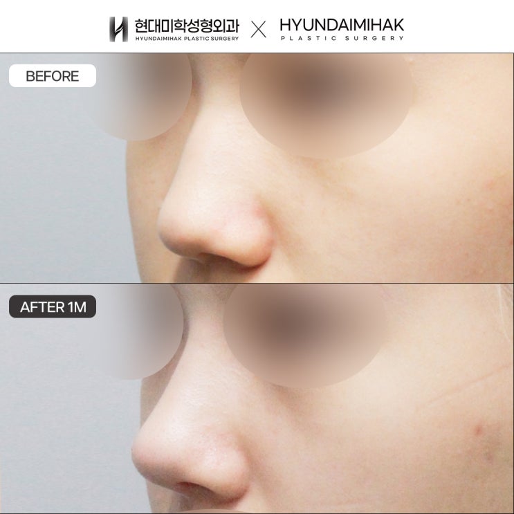 If You Want Low-Nose Rhinoplasty Without Failure