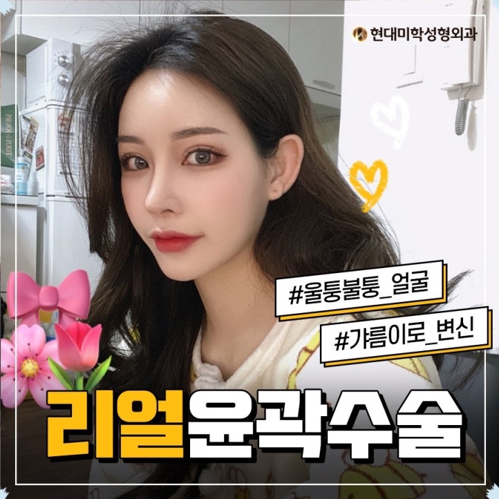 Facial contouring surgery cost: I keep looking in the mirror