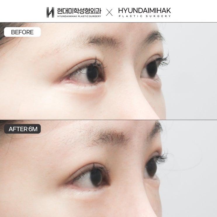 Safe and Satisfying Results for Lateral Canthoplasty Revision