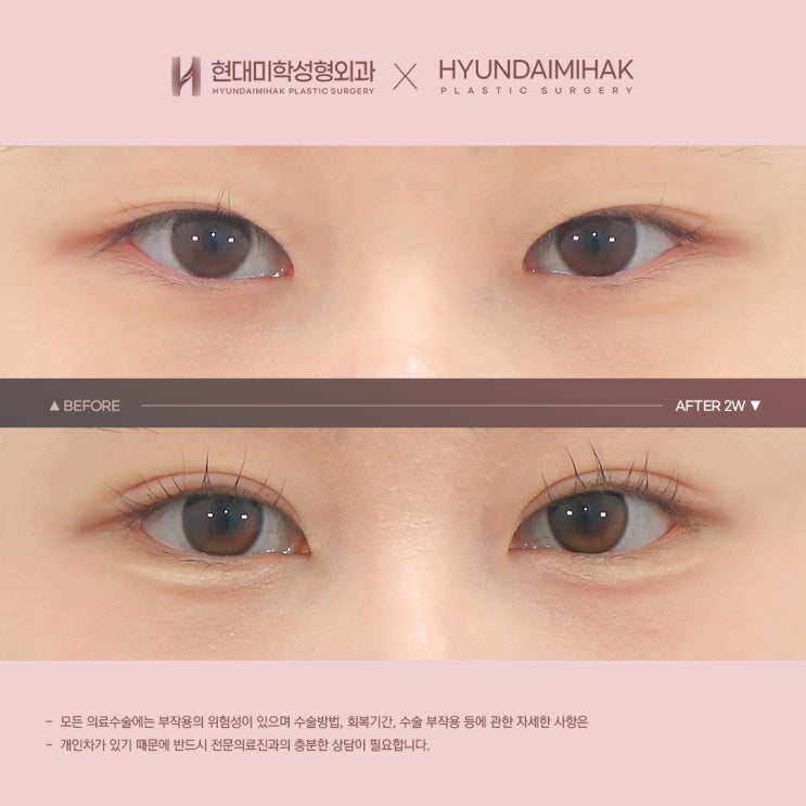 Referring to the price of non-incisional double eyelid surgery while naturally enhancing the eyes