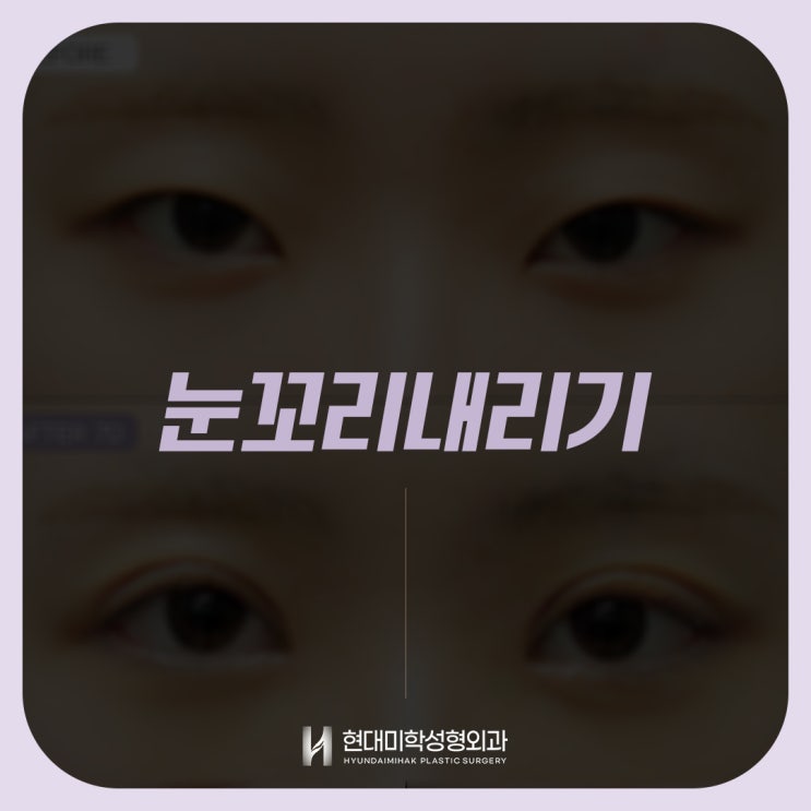 Changing Your First Impression with Lowering the Outer Eye Corners to Create a Gentle, Puppy-Like Face