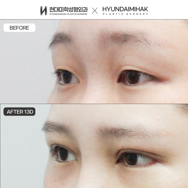 Before and After Incisional Ptosis Correction: A Clearer, More Natural Change in the Eyes