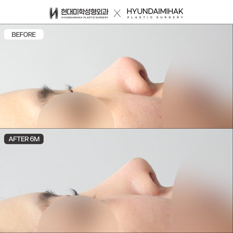 Tip-Lowering Surgery for an Upturned, Short Nose