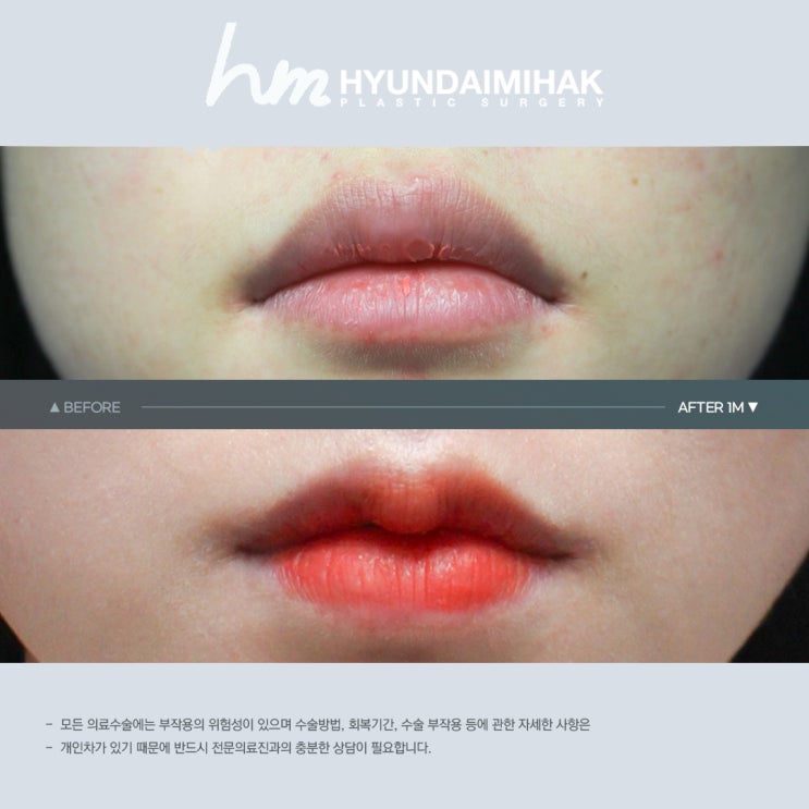 Lip Surgery Cost: The Most Realistic Choice for Becoming More Beautiful