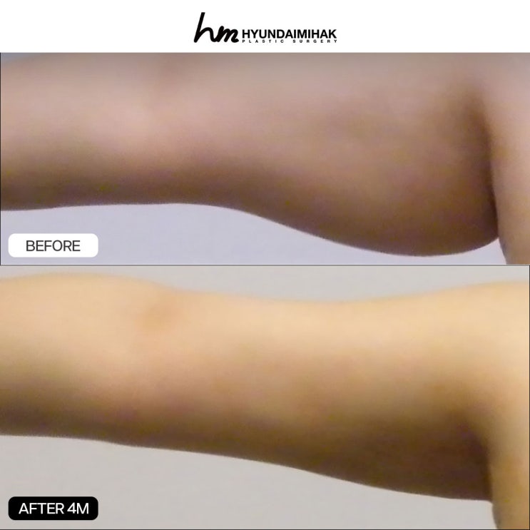 Arm Liposuction Surgery: A Must-Know Checklist