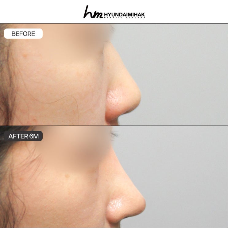 Donated Rib Cartilage: A Low-Burden Rhinoplasty Solution for Revision Surgery