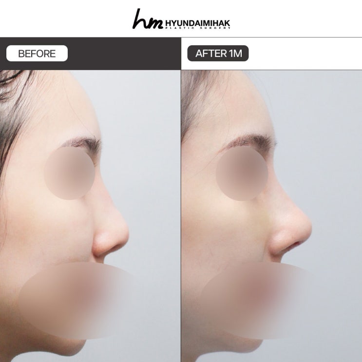 Gangnam Nose Revision Surgery: From Identifying the Cause of Failure to Presenting a Solution