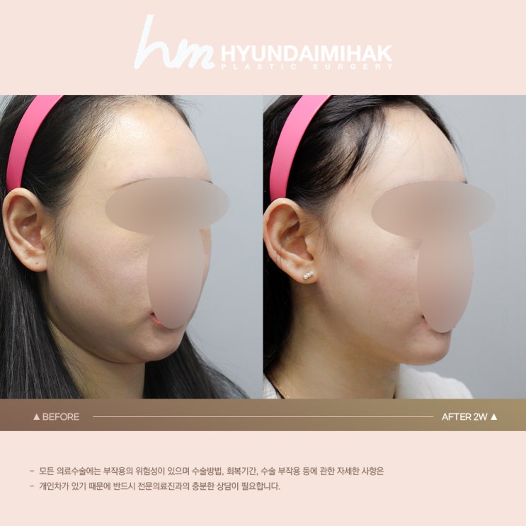 When sagging chin fat does not improve with dieting, what is the solution?